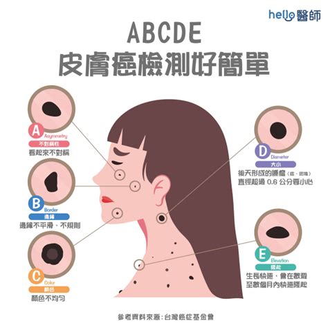 痣變色|健康網》長痣＝皮膚癌？ 醫提7症狀：善用ABCDE原。